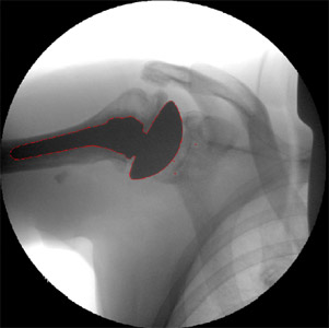 Figure 13 Typical fluoroscopic image of the shoulder with TSA after being automatically segmented and manually adjusted for ancillary outlines.