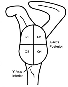 Figure 15 Left scapula shown with glenoid component. Cartesian coordinate system is created with the origin at the geometric center of the component.