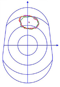 Figure 20 Digitized voided silicon area on the glenoid component.