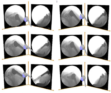 Figure 27 A virtual dual plane fluoroscopic imaging system with TSA components in an abduction / adduction animation sequence. The cycle begins in the top image with a humeral abduction of 28° to the vertical, peaks in the third image at 55° and ends with the bottom image at 23°.