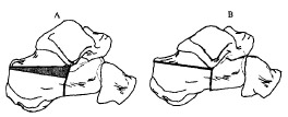 Fig. 1. Schematic description of the imposed calcaneal fracture showing (A) the primary and secondary fracture line and the resected wedge (shaded area); (B) the resulting shape of the calcaneus.