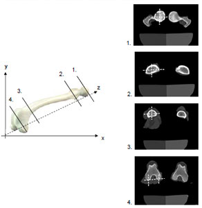 Abb. 3.10: Schnittebenen durch das Os femoris. 1. Femurkopf-Aufnahme, 2. Proximale Schaft-Aufnahme in Hhe des Trochanter minor, 3. Distale Schaft-Aufnahme proximal der Tuberostias supracondylaris, 4. Kondylen-Aufnahme.