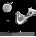 Abb. 3.6: CT-Schnittbild durch Femurkopf (links) und Acetabulum (rechts). Am unteren Bildrand ist das Phantom zu sehen. 1 Fovea capitis mit Lig. capitis ossis femoris (Pfeil), 2 Pfannendach, 3 Ventralrand Acetabulum, 4 Fossa acetabuli mit Inc. acetabuli, 5 Phantom, Wasserquivalent, 6 Phantom, Spongiosaquivalent.