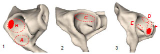 Abb. 4.1: Schematische Darstellung der Lokalisation der Knorpelschden A-F in einem linken Acetabulum, Ansicht von 1 kaudolateral, 2 lateral, 3 kraniolateral; A Schden am Vorderhorn, B an der Kraniodorsalflche, C im Pfannendach, D am bergang zum Hinterhorn dorsal, E ventral, F Schden am Hinterhorn; tief angefrbte Bereiche bezeichnen die Stellen der hufigsten Lokalisation.