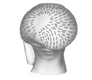 Abb. 4.16: Schematische Darstellung der Spaltlinien des Gelenkknorpels an der Medialflche des Caput ossis femoris; um die Fovea capitis herum sind die Spalten strahlenfrmig angeordnet.