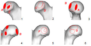 Abb. 4.2: Schematische Darstellung der Lokalisation der Knorpelschden A-G am Femurkopf; 1-2 Ansicht von kranial, 3 Ansicht von medial, 4-6 Ansicht von kaudal; A,C,D Schden an der Kranialflche, A, B am  Rand der Fovea capitis, E-G an der Kaudalflche; tief angefrbte Bereiche stellen Orte hufiger, massiver Schdigungen dar.