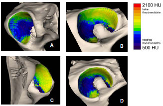 Abb. 4.20: Verteilungsmuster der subchondralen Knochendichte im Acetabulum eines ca. 2 Jahre alten, mnnlichen Mischlingshundes; A Kranialflche, B Dorsalflche, C Kaudalflche, D gesamte Gelenkflche im berblick