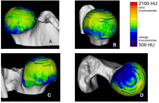 Abb. 4.22: Knochendichteverteilung am Femurkopf eines Berner Sennenhund-Mischlings, ca. 2 Jahre alt, mnnlich; A Kranialflche, B Medialflche, C Kaudalflche, D Dorsalflche.