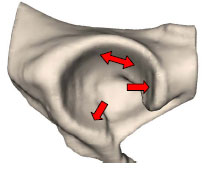 Abb. 5.3: Schematische Darstellung des Aufbiegens des Acetabulum unter Belastung.