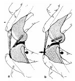 Abb. 3: Prfung der Stabilitt des Lig. cruciatum craniale bzw. Vorhandensein der vorderen Schublade. a Keine Verschieblichkeit; b Verschieblichkeit der Tibia nach vorderer Kreuzbandruptur nach kranial mglich (aus: Brunnberg, 1989b);