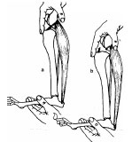 Abb. 4: Tibia-Kompressions-Test: a Keine Subluxation bei intaktem vorderen Kreuzband; b Subluxation des Tibiakopfes nach vorderer Kreuzbandruptur (aus: Brunnberg, 1989b);