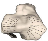 Abb. 21: Summationsbild der Knorpelspaltlinien an den Kondylen der linken Tibia (Ansicht von proximal).