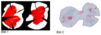 Abb. 27: Vergleich der Kontaktflchen in der Belastungsstufe 100%, 314N (W2-26, rechte Tibia) Bild 1: Silikonabdruck Bild 2: Druckfilm (Fuji SLow)