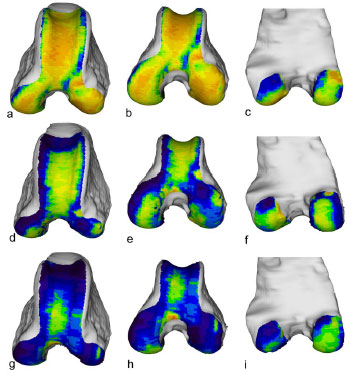 Abb. 33: Vergleichende Darstellung der individuellen Knochendichteverteilung der Facies articularis femoris von drei verschiedenen Hunden. a - c: linker Femur eines Boxers, weiblich, 23 kg, Altersgruppe III (Hd 33) d - f: linker Femur eines DSH, mnnlich, 25 kg, Altersgruppe II (Hd DSH1) g - i: linker Femur eines Pudels-Mischlings, mnnlich, 8 kg, Altersgruppe III (Hd Pu2) Von links nach rechts: Ansicht von kranial, kraniodistal und kaudal.