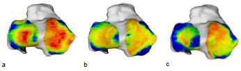 Abb. 40: Vergleichende Darstellung der individuellen Knochendichteverteilung der Facies articularis tibiae von drei verschiedenen Hunden. a: rechte Tibia eines Mischlings, mnnlich, 21 kg, Altersgruppe III (Hd 28) b: linke Tibia eines DSH, mnnlich, 25 kg, Altersgruppe II (Hd DSH) c: linke Tibia eines Airdale Terriers, mnnlich, 26,5 kg, Altersgruppe III (Hd 39). Ansicht der Tibiagelenkflche.