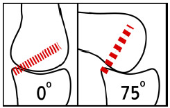 Figure 2-3: Schematic demonstrating the functional behavior of the posterior cruciate ligament. In extension the fibers are predominantly lax, but as the knee flexes the fibers become stretched. This tension is thought to cause the posterior translation of the femur known as 'rollback'.