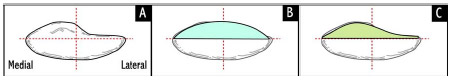 Figure 2-5: Superior schematic view of patella (A), symmetric dome implant (B), and anatomical or asymmetric implant (C). Median crest of patella is 5.5 mm medial to red midline. The amount of residual bone after cutting is typically between 10-15mm.