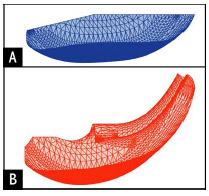 Figure 4-1: Sagittal profiles of the two tibial inserts simulated within this study: (A) condylar and (B) ultraconforming