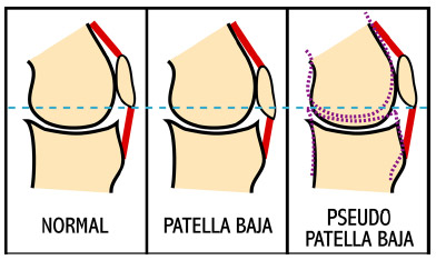 Figure 5-1: Schematic illustrating the physical differences between the true presentation of patella baja and the pseudo patella baja condition. True patella baja has a shortening of the patellar tendon, while in the pseudo patella baja condition the patellar tendon length remains consistent. Note that, the superior-inferior position of the patella relative to the horizontal reference (dashed blue line) remains consistent between the normal and pseudo patella baja conditions. The dashed purple lines represent joint line elevation following TKR.