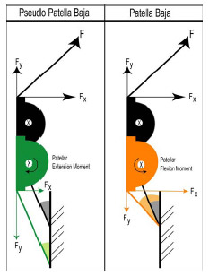 Figure 5-11: Due the angle of the patellar tendon with respect to the long axis of the tibia, a patella baja condition creates a patellar flexion moment. The black patella represents normal patellar height.