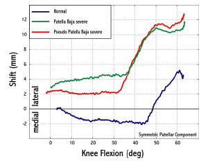 Figure 5-6: Any reduction of patellar height increased patellar lateral shift from normal conditions for flexion angles greater than 30. For normal conditions the patella tracked medially for 2 mm before tracking laterally for 7 mm after 45 flexion.