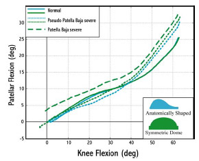 Figure 5-8: For pseudo patellar baja conditions the patellar flexion angle was greater than normal patellar height conditions at flexion angles 45 and higher. Patellar flexion angle was greater for all flexion angles for patella baja conditions as opposed to pseudo patella baja conditions.