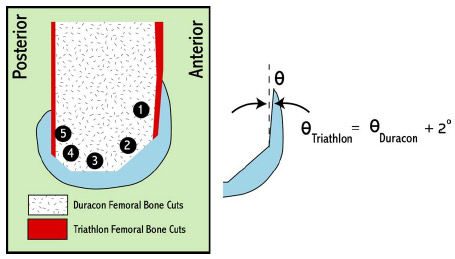 Figure 6-1: The Triathlon CR design (Stryker Orthopaedics; Mahwah, NJ) required a 2 greater femoral anterior cut than the Duracon CR design (Stryker Orthopaedics; Mahwah, NJ). Cut plane designations are represented by a black circle with number.