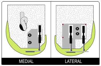 Figure 6-3: Schematic illustrating the mounting of DVRTs on foam block. Aluminum mounting plates were glued in the same location on each block. The DVRT mounting plate could then be bolted to each mounting plate, securing the DVRT to the foam block. Divot holes (red dots) were machined into the lateral plate to establish a block-fixed coordinate system. A knot was tied into the climbing rope used to simulate the posterior cruciate ligament.