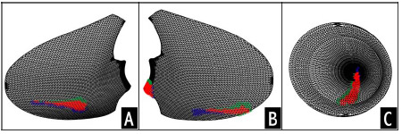 Figure A-4: Computed contact areas on the lateral (A) and medial (B) tibial condyle and the patellar component (C). Blue areas signify contact area from set of registration matrices, green areas signify contact area from the other set of registration matrices, while red area represent overlapping contact area. On average the overlapping area represented more than 75% of the total contact area indicating good agreement between sets of registration transformations.