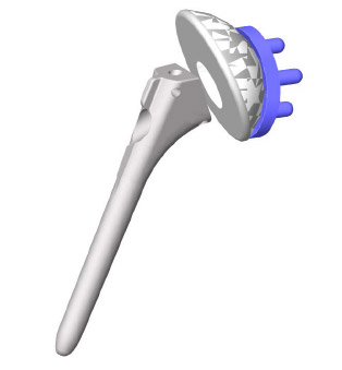 Figure 2 Typical total shoulder arthroplasty components.