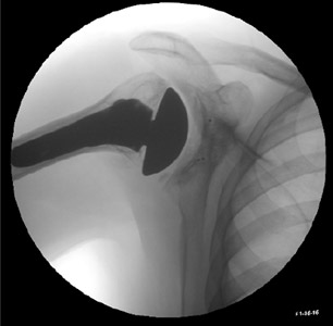 Figure 10 Typical fluoroscopic image of the shoulder with TSA.