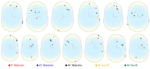 Figure 21 Unscaled patient specific contact locations on the glenoid surface as a function of arm position, shown by color code. All right shoulder contact locations were mirrored to left glenoid components.