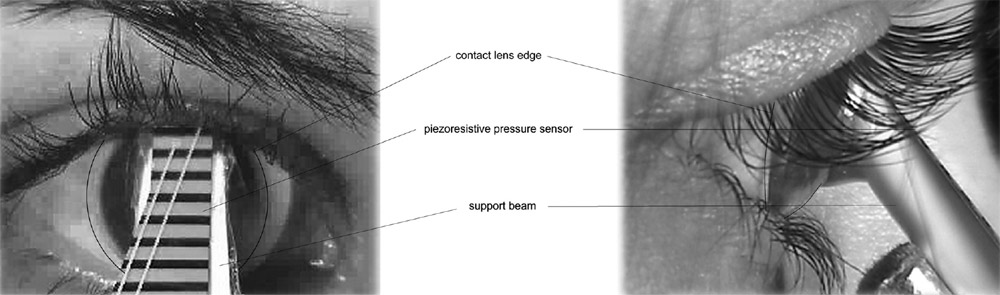 front and side view of eyelid presure