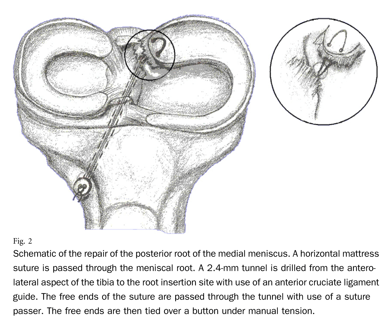 repair-of-the-posterior-root