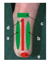 Loadable areas (ON1 - a, ON2 - b, ON3 - c) and unloadable areas (NON4 - d, NON5 - e) on the transtibial stump