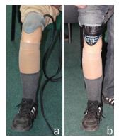 Pressure sensor placement methods- a)stump/liner, b) liner/socket